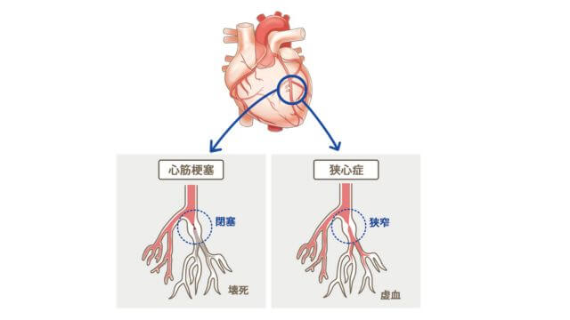 心筋梗塞と狭心症の違い